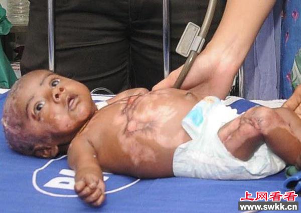 印度男婴三个月自燃四次 罕见人体自燃症大揭秘