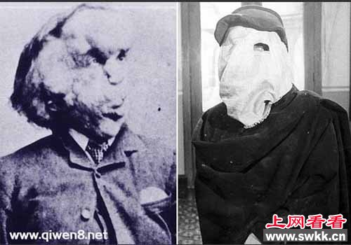 19世纪怪胎“大象人”约瑟夫【图】
