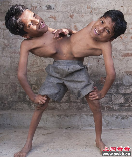 印度连体兄弟 共享四只胳膊和两条腿 组图