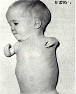 人间悲剧——海豚儿婴儿一种罕见的无肢畸形和短肢畸形婴儿的出生迅速增多。被称为“海豚儿”。