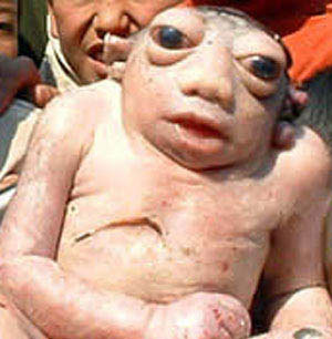 奇特婴儿竟没有脖子 　　但是，他出生不到半小时就死亡了。