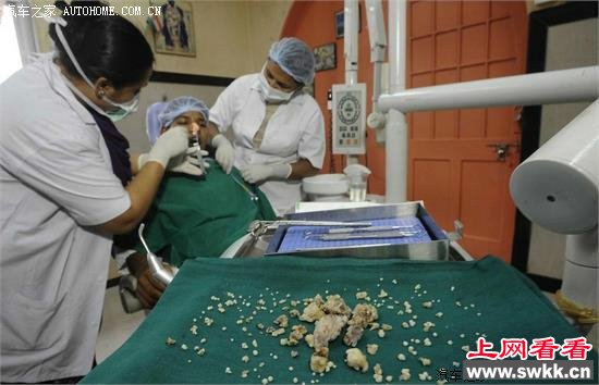 牙齿最多的人 印度少年嘴中取出232颗牙 图