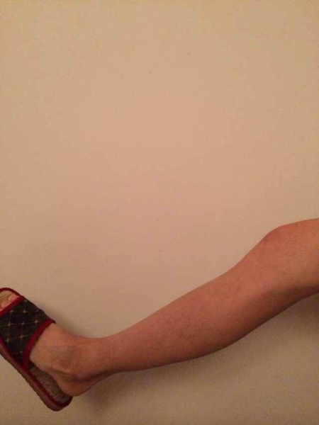 身高169仅39kg女孩节食减肥瘦成骨架 图