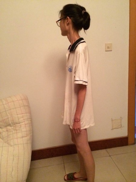 身高169仅39kg女孩节食减肥瘦成骨架 图