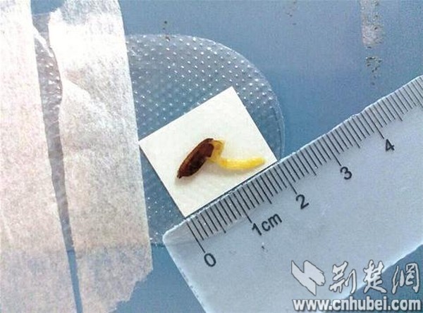 男子眼中不慎进稻谷 数天后长出嫩芽 图