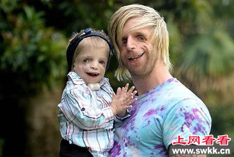 男子患先天“怪脸”症鼓励病友活精彩人生（图）
