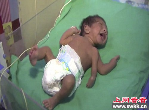 印度男婴长出三只手臂 出现概率为百万分之一