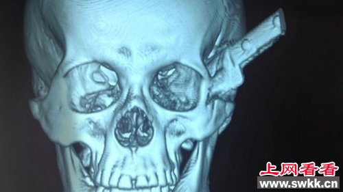 巴西男子头部被刺穿“自驾”摩托前往医院（图）