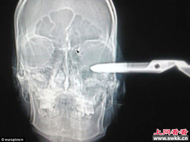 墨西哥绅士男子剪刀插脑就医“我有点小问题”
