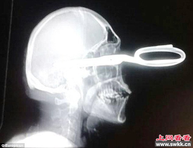 墨西哥绅士男子剪刀插脑就医“我有点小问题”