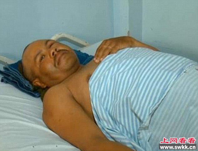 墨西哥绅士男子剪刀插脑就医“我有点小问题”