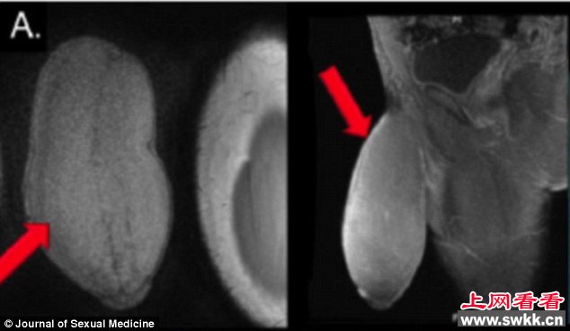 最大的阴茎 少年做世界首例阴茎缩小手术(组图)