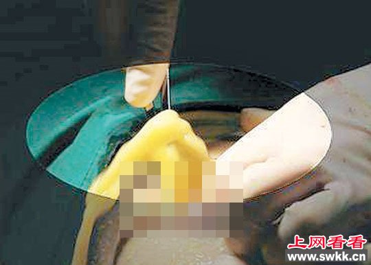 女子注射PAAG隆胸13年后前胸移到后背