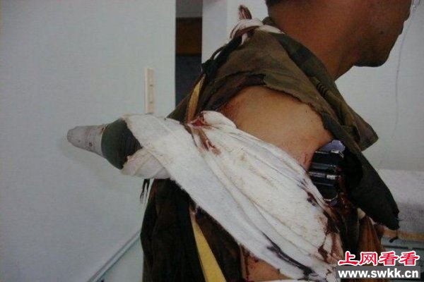 血腥恐怖分子肩被炮弹击穿捡回一条小命