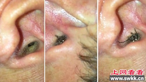 惊悚：男子耳部不适发现竟有蜘蛛爬进爬出（图）