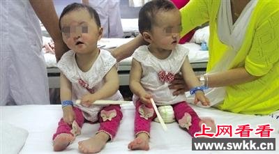河南双胞胎女童患怪病 头颅畸形手脚像