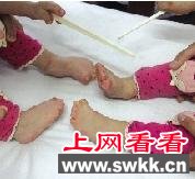 河南双胞胎女童患怪病 头颅畸形手脚像