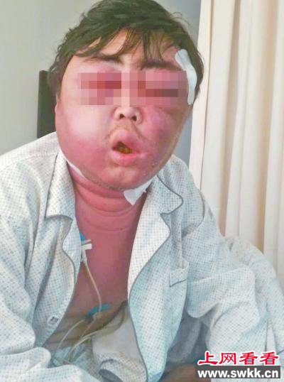 男子被蚊子叮一口脸肿成“球” 医院下病危书