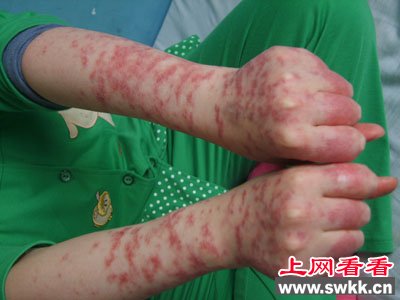 红斑狼疮