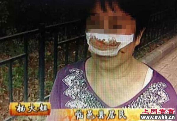 鼻子被丈夫咬掉吐下肚 只因未及时接电话