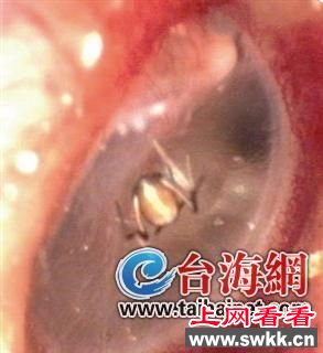 女子耳内夹出蜘蛛 昆虫入耳怎么办？