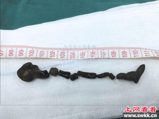 医生从患者胆管内取出的蛔虫形结石长达11厘米