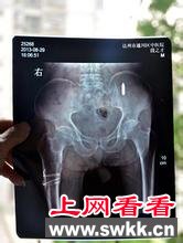 90岁老兵体内藏弹头68年