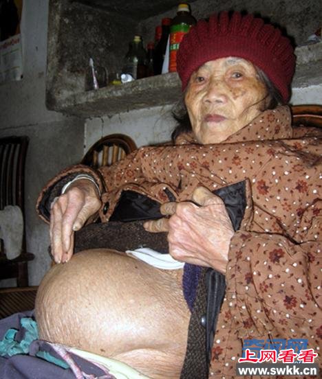 老妇腹中竟存58年胎儿 肚子大得跟篮球一样大