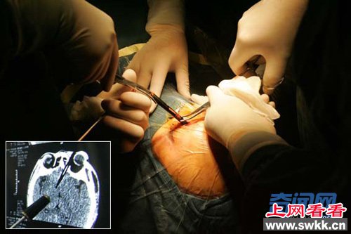 铅笔插入脑中55年 女子55年后取出脑中铅笔