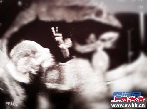 妈妈做B超发现胎儿摆V字 难道他的愿望是世界和平