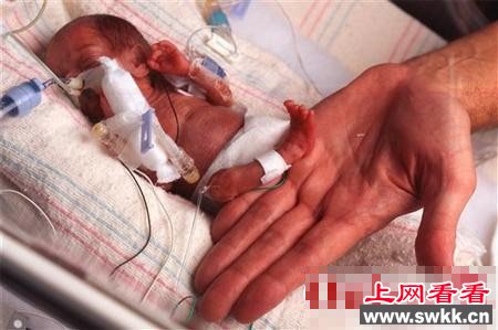 世界最早产的婴儿 仅有手掌那么大