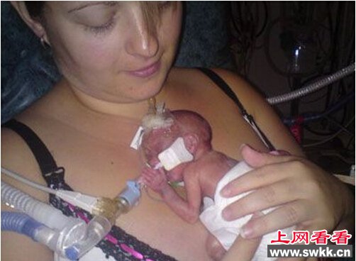 世界最早产的婴儿 仅有手掌那么大
