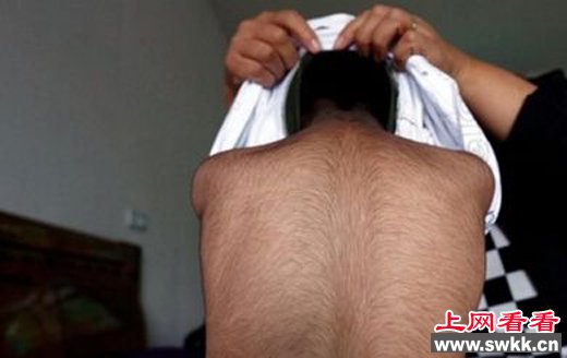 男童长满黑毛 难以融入同龄儿童