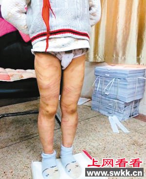 南京养父母虐待男童