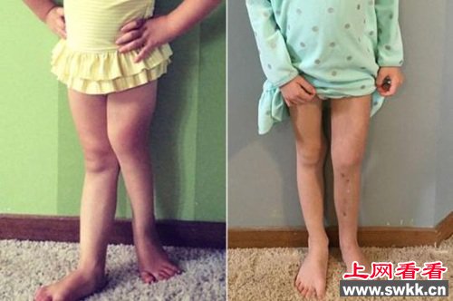 女孩左腿短11厘米