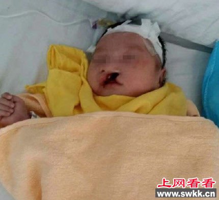 兔唇男婴被弃荒野