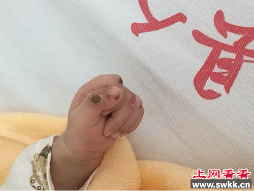 兔唇男婴被弃荒野
