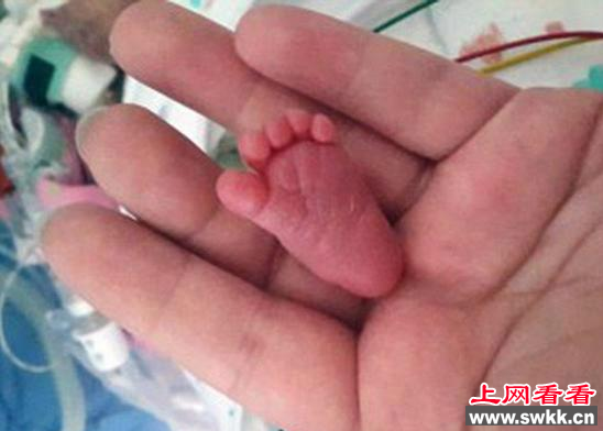 世界上出生最轻的婴儿