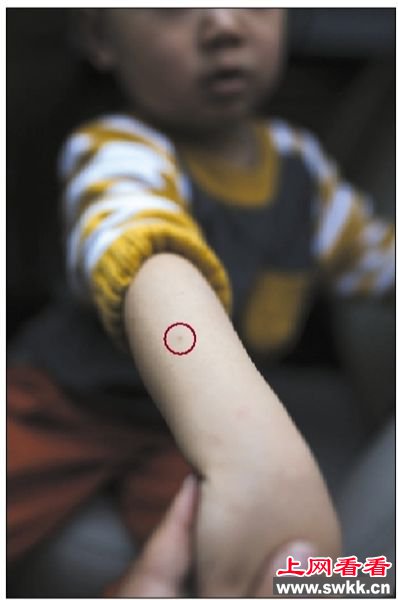 幼儿园老师针扎幼童
