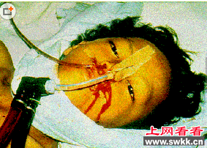 埃博拉病毒死者照片