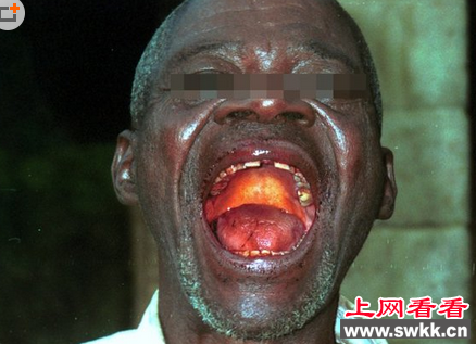 埃博拉病毒死者照片