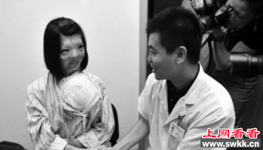 福建毁容少女将换脸