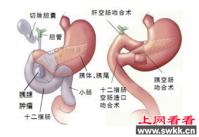 胰十二指肠切除术示意图