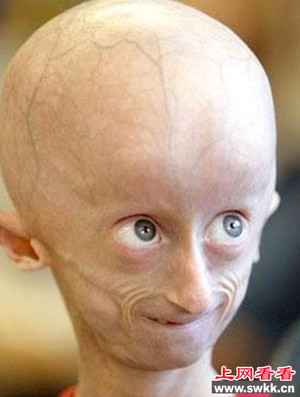 美国17岁早衰症男孩