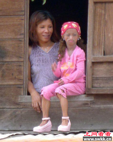 菲律宾早衰症女孩