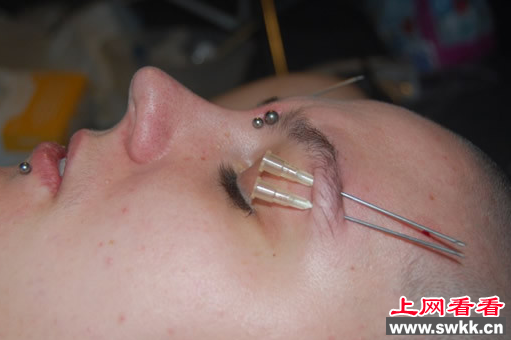 人体穿刺
