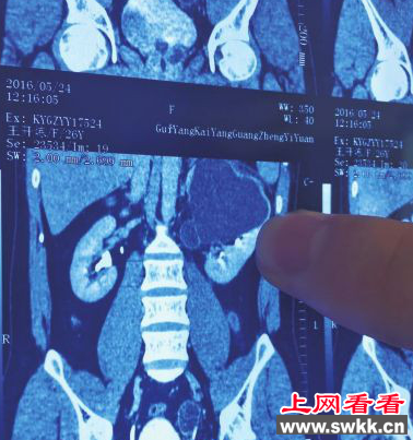 男子长四个肾 