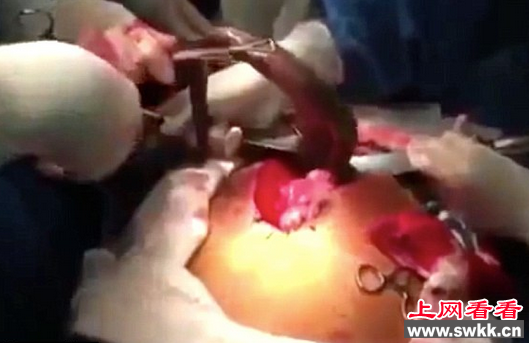 巴西男子肠道内取出活鱼