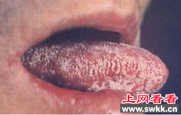 艾滋病初期舌头症状