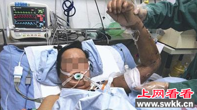 漳州农妇被胡蜂蛰上百下差点丧命